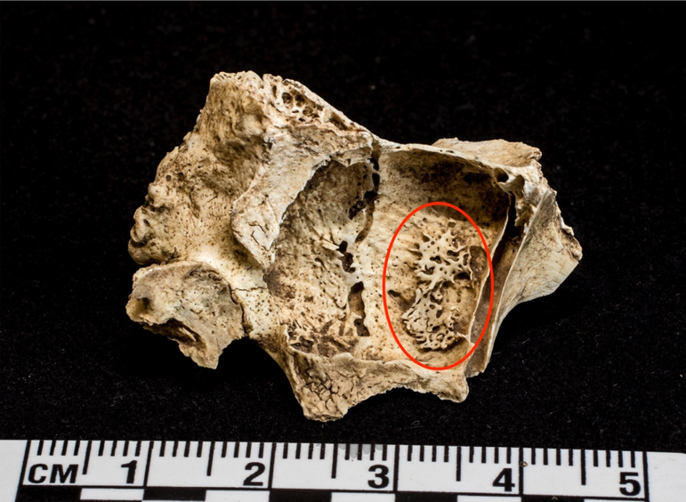 Section of maxillary sinus measuring 4cm in length. The area circled in red shows evidence of new bone formation in the sinus cavity due to sinusitis.