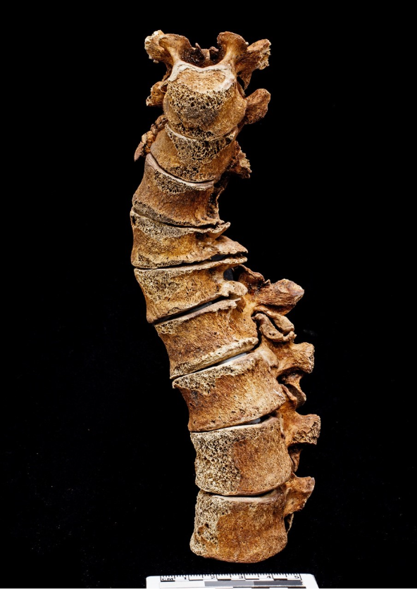 A dark brown, spongy, section of a spine, with nine vertibrae stacked on top of each other.