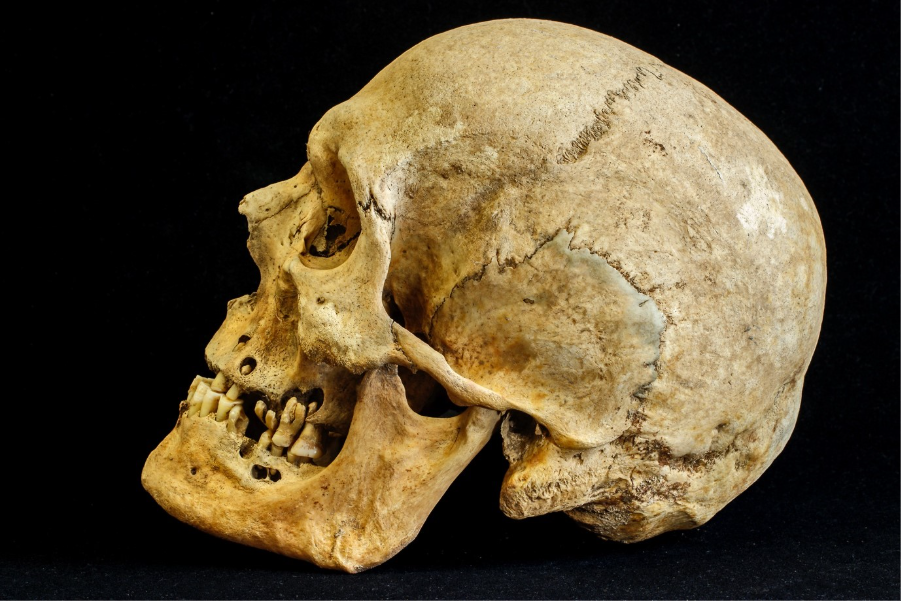 Side-on view of a human skull against a black background. The bone is yellow-brown and the lower jaw is still attached. 