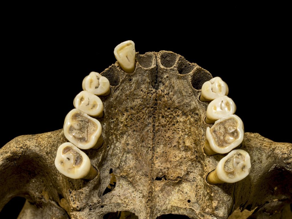 Image of a top jaw showing the top teeth from below. The bone is yellow and brown and shows a set of white-yellow teeth where five front teeth are missing. 